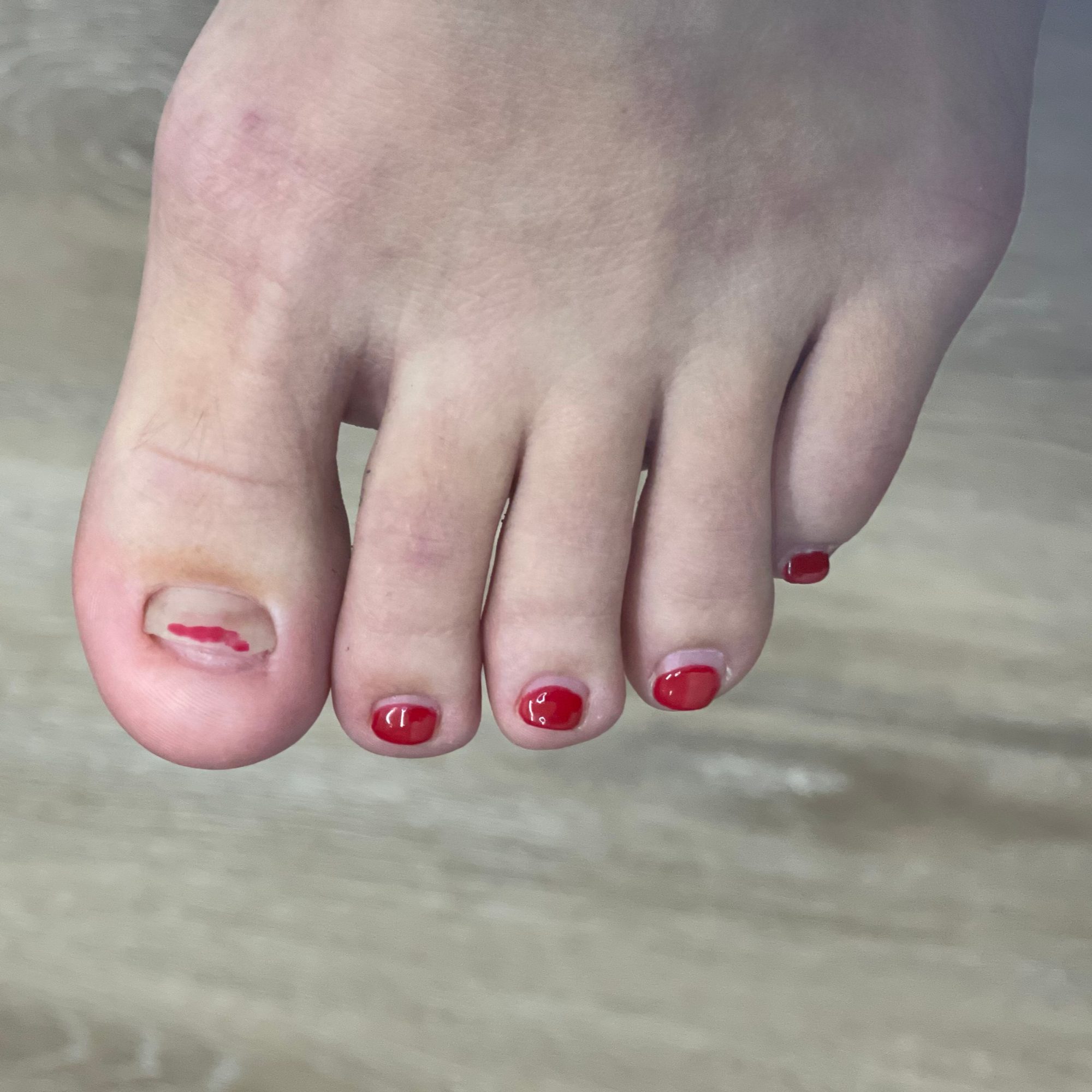 Toenail restoration — before
