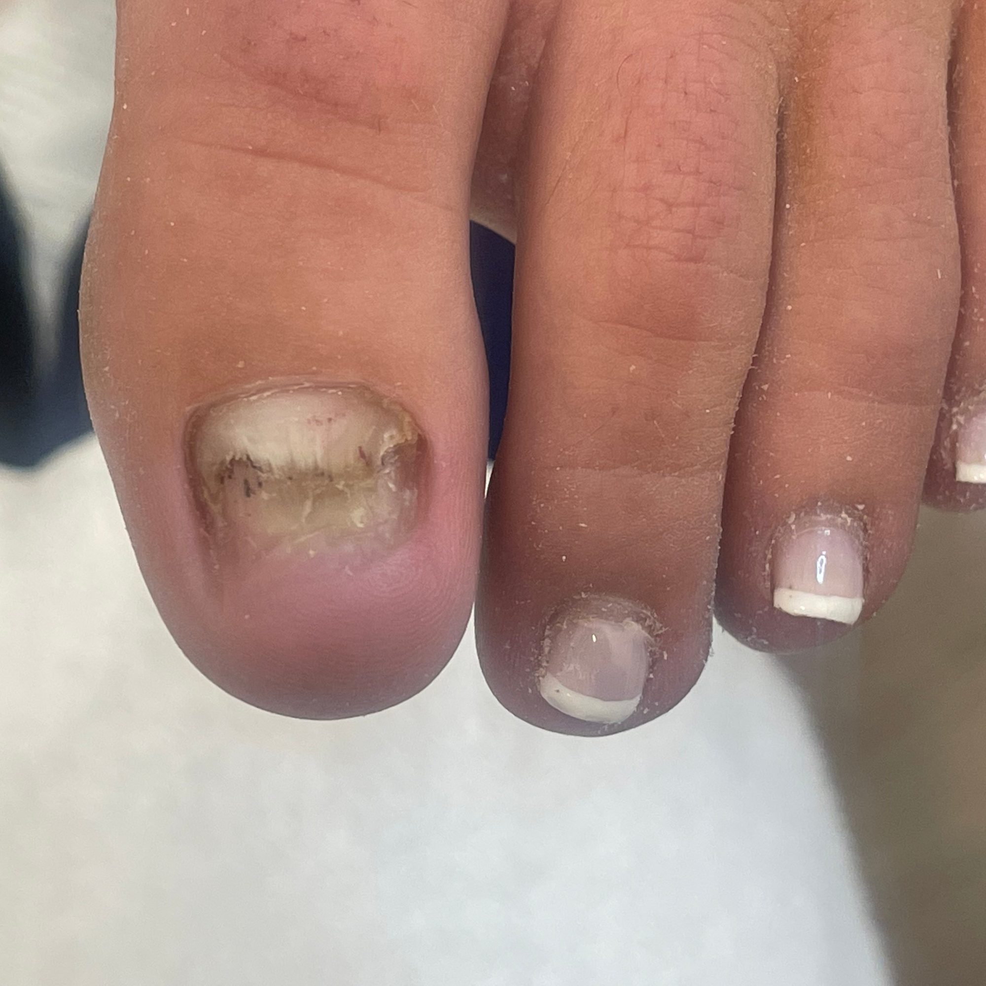 Toenail restoration — before