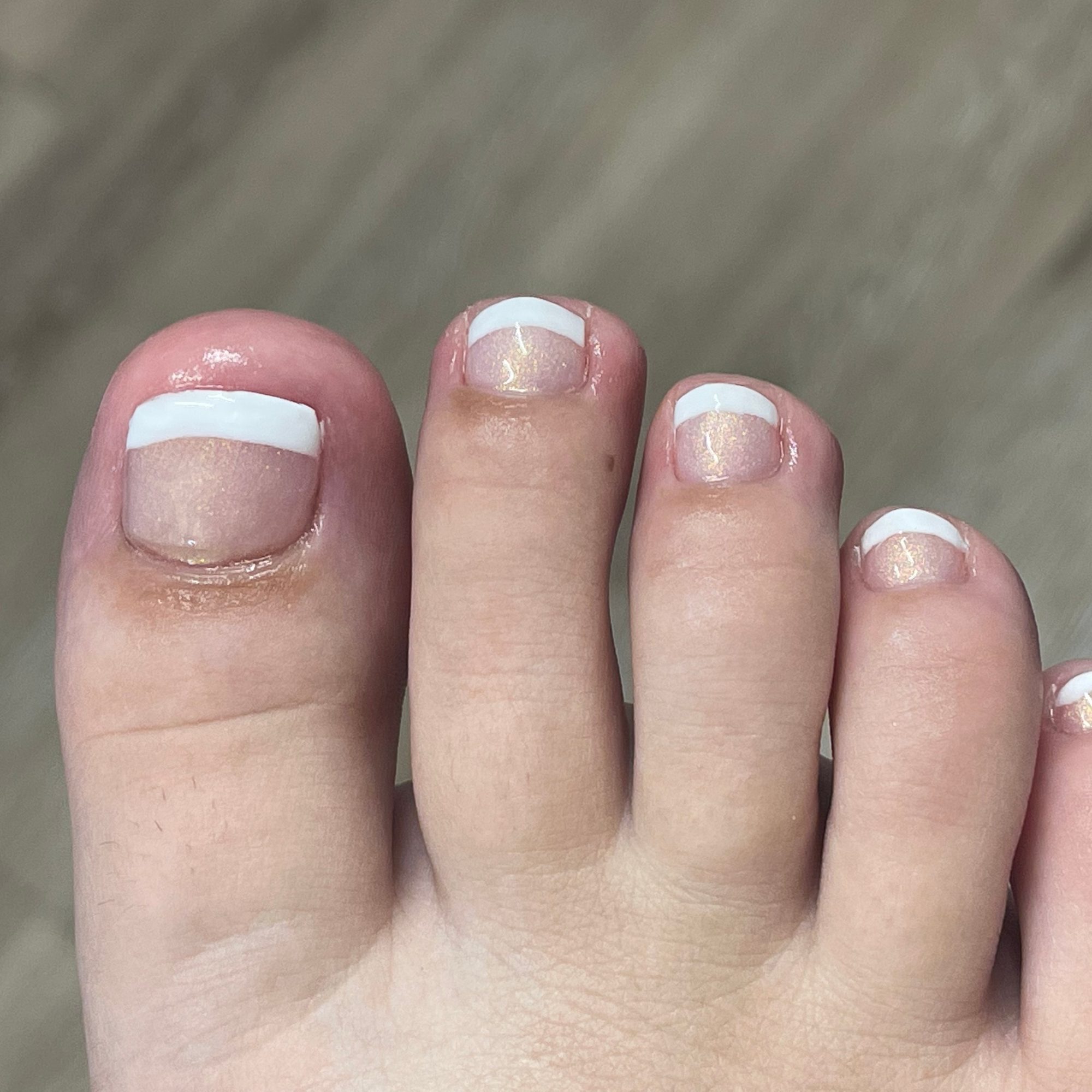 Toenail restoration — after