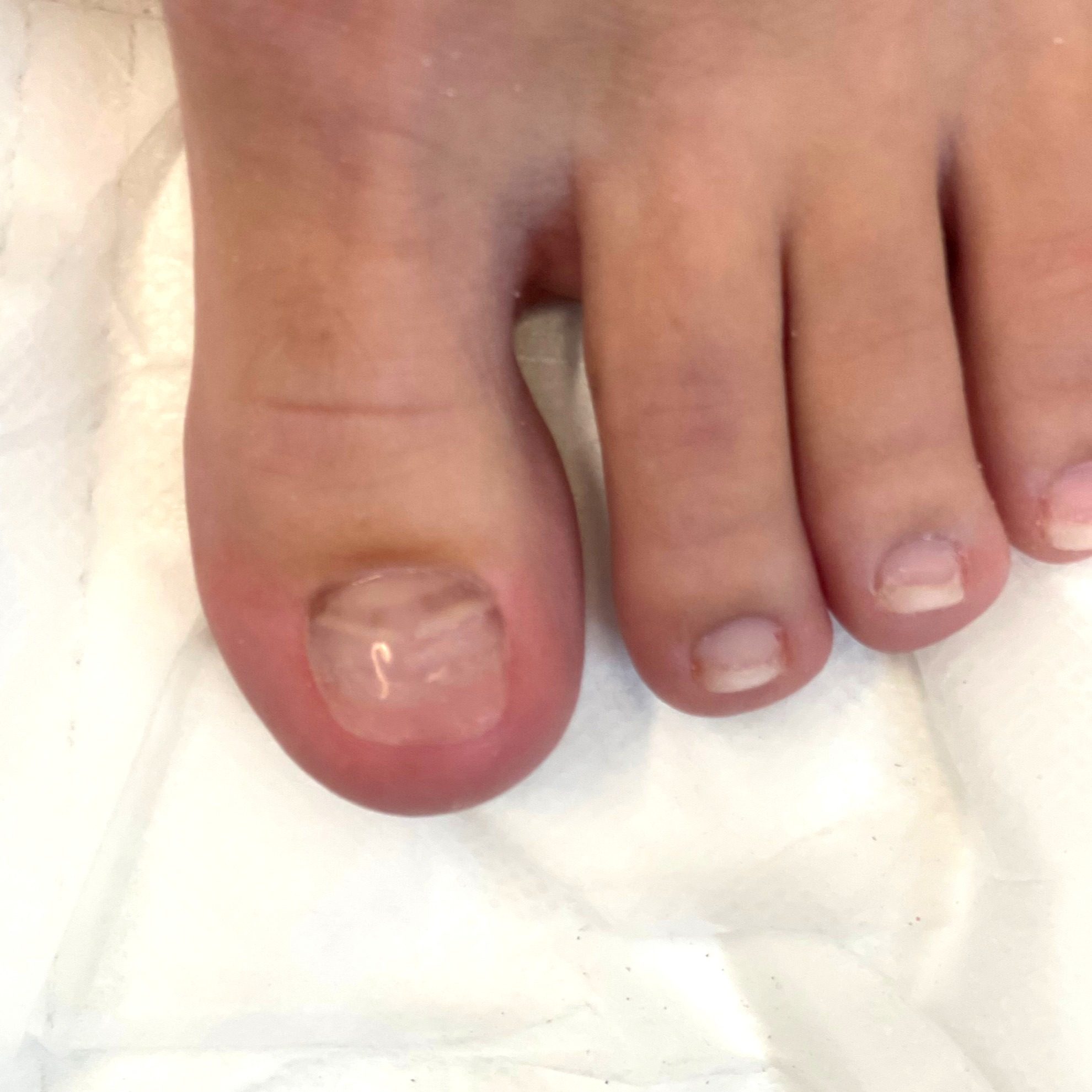 Toenail restoration — after