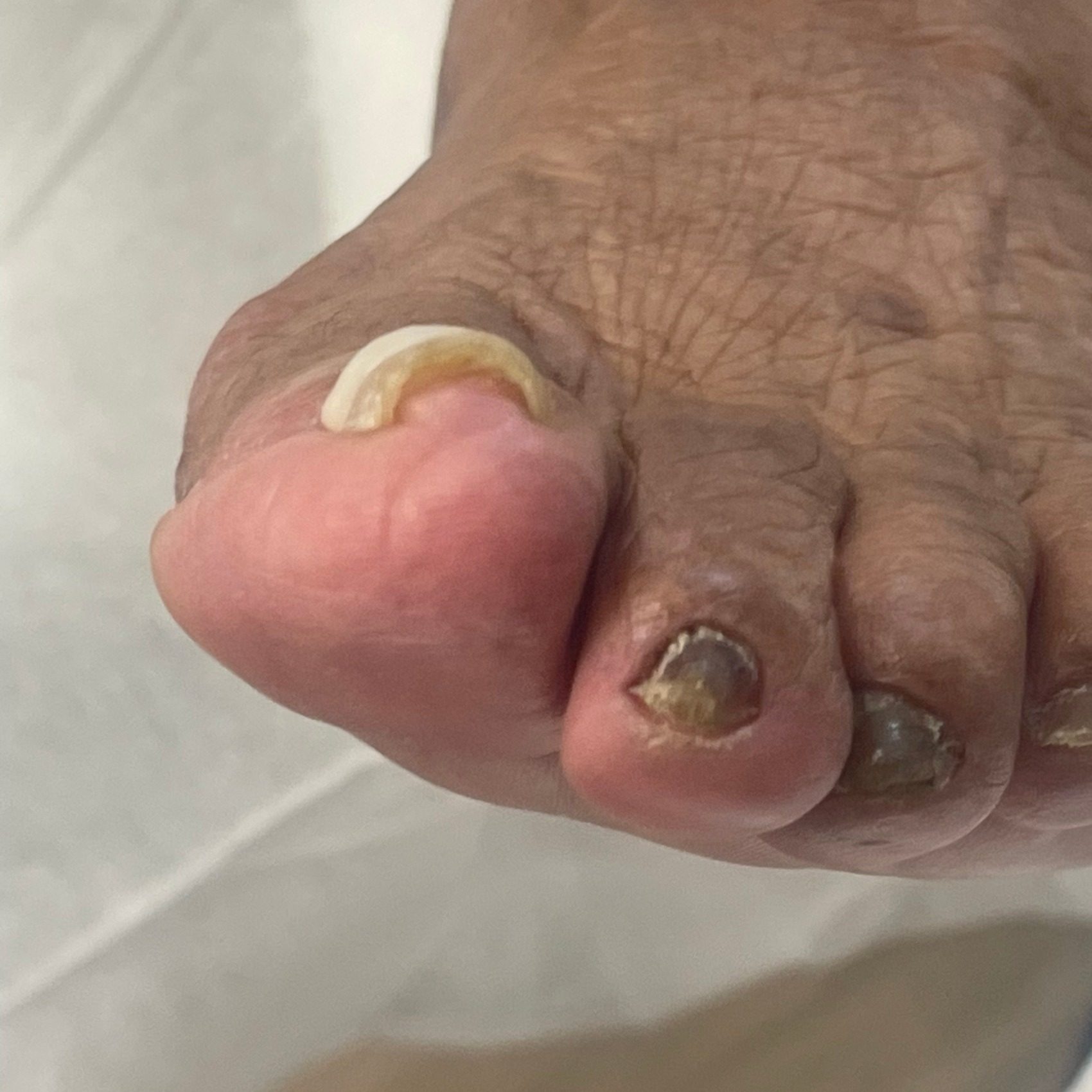Ingrown nail correction — before