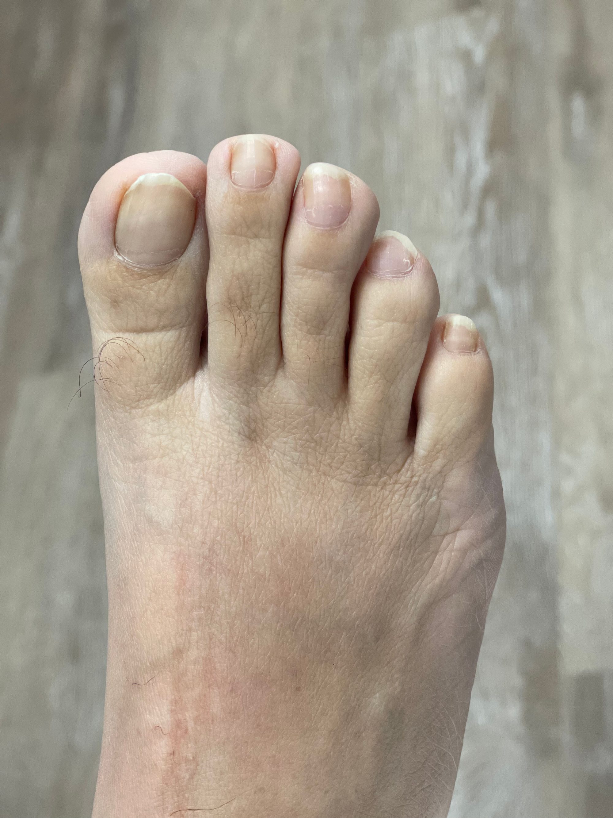 Ingrown nail correction — before