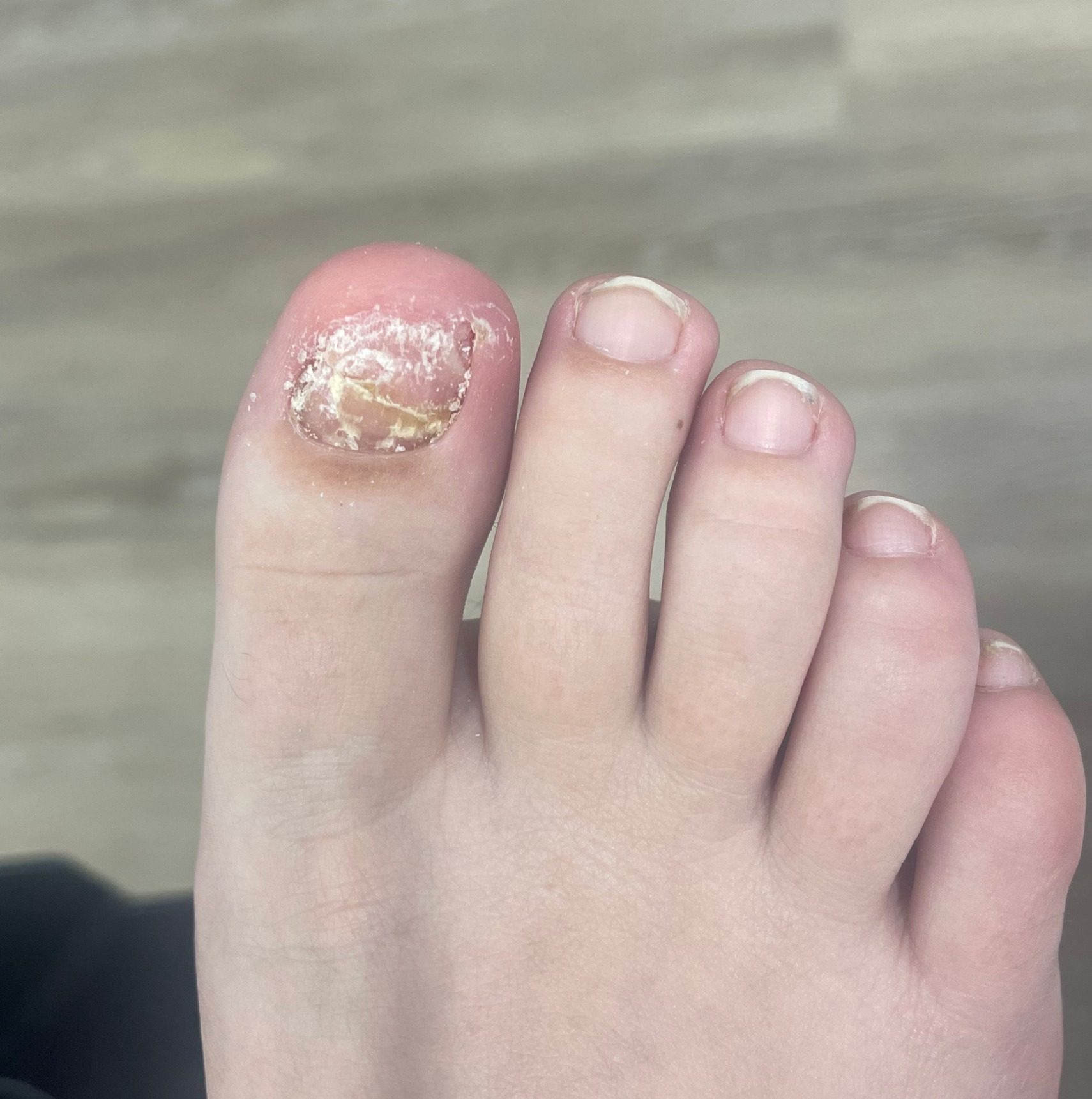 Toenail restoration — before