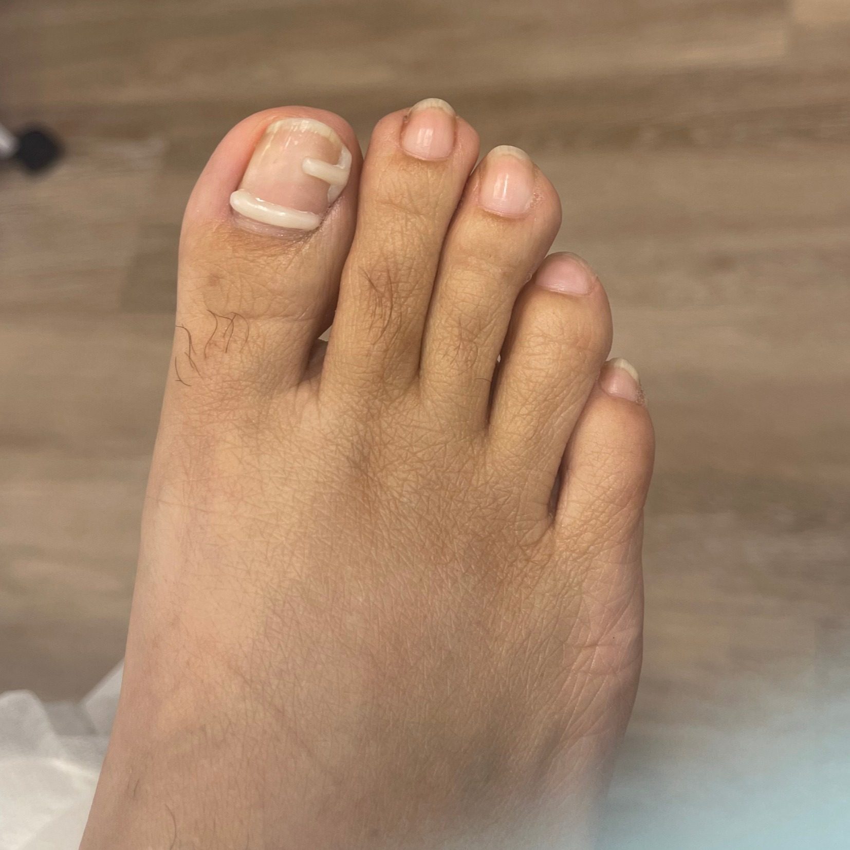 Ingrown nail correction — after