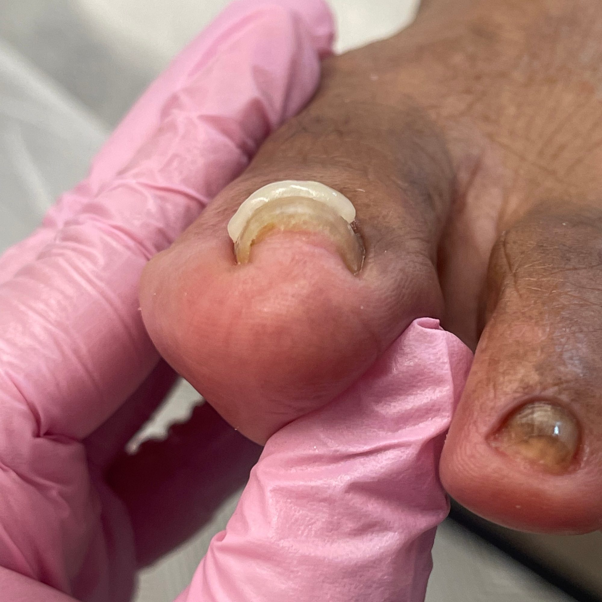 Ingrown nail correction — after
